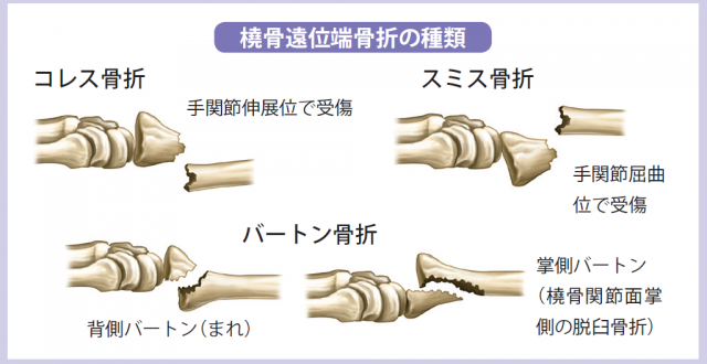 高齢でもできる 骨折 手術後 後遺症で 曲げれない手首を動かせる リハビリ方法