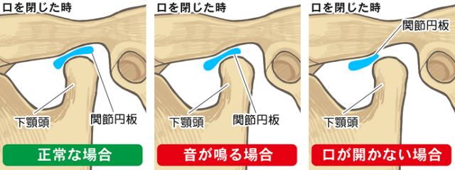 あくびをすると ガコっ と鳴る 硬いものを食べると耳から顎が痛い 顎関節症 の整骨院での治し方