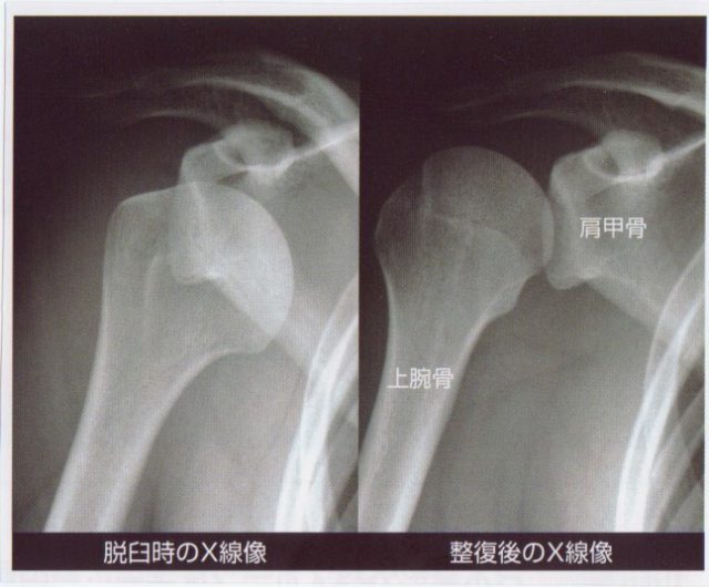 コンタクトスポーツに多い 肩関節脱臼 のリハビリ方法