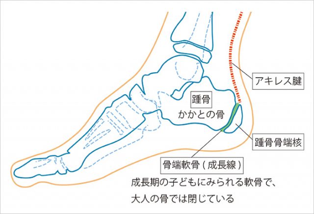 歩くとカカトまで痛い 足底腱膜炎 には足裏に クッション を入れると楽になる