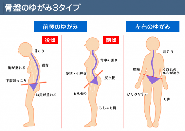 分離症 ぶんりしょう と すべり症 の違いとは